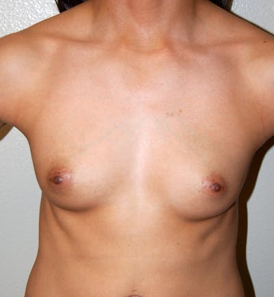 Breast Augmentation Before & After Gallery - Patient 968148 - Image 1