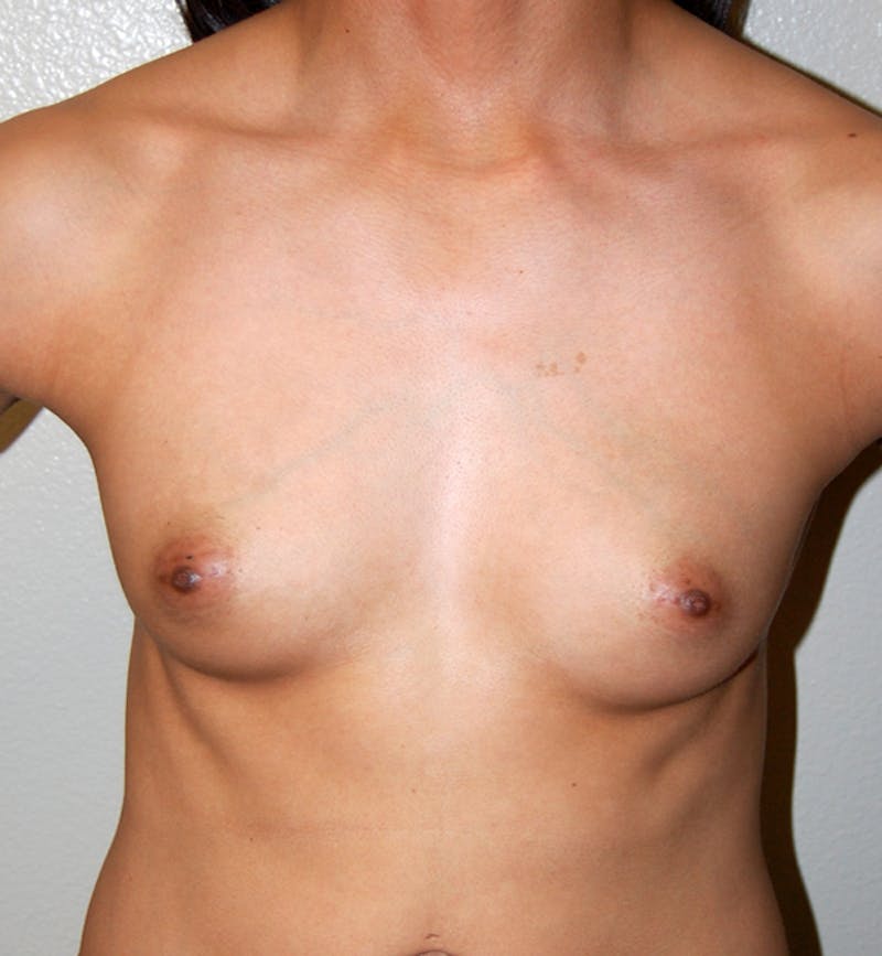 Breast Augmentation Before & After Gallery - Patient 968148 - Image 1
