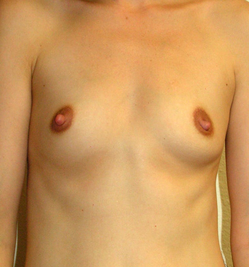 Breast Augmentation Before & After Gallery - Patient 412240 - Image 1
