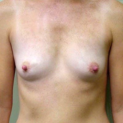 Breast Augmentation Before & After Gallery - Patient 153336 - Image 1