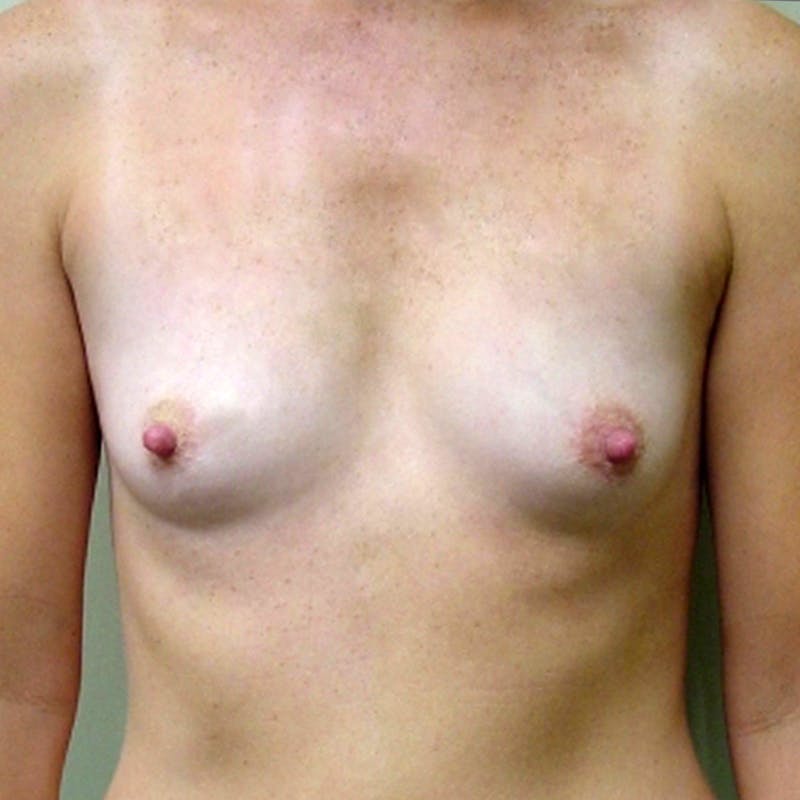 Breast Augmentation Before & After Gallery - Patient 153336 - Image 1