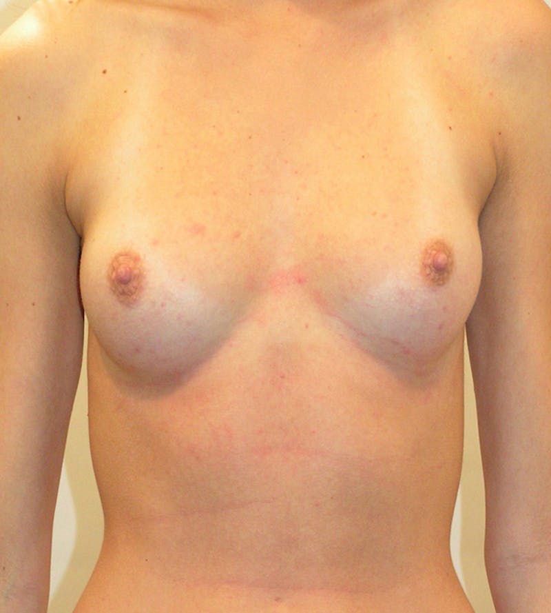 Breast Augmentation Before & After Gallery - Patient 798067 - Image 1