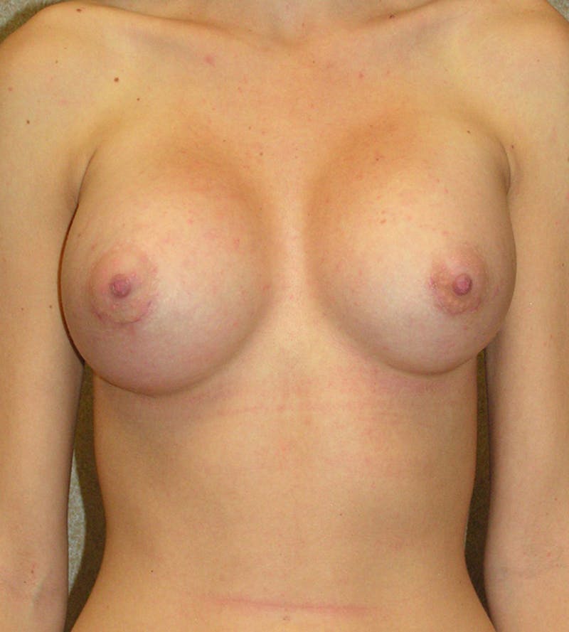 Breast Augmentation Before & After Gallery - Patient 798067 - Image 2