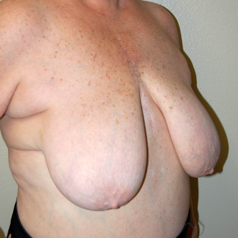 Breast Mastopexy Before & After Gallery - Patient 310898 - Image 3