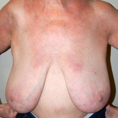 Breast Mastopexy Before & After Gallery - Patient 135290 - Image 1