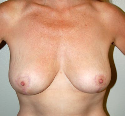 Breast Mastopexy Before & After Gallery - Patient 215524 - Image 2
