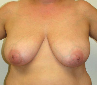 Breast Mastopexy Before & After Gallery - Patient 386519 - Image 1