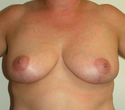 Breast Mastopexy Before & After Gallery - Patient 386519 - Image 2