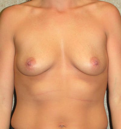 Mastopexy Augmentation Before & After Gallery - Patient 121378 - Image 1