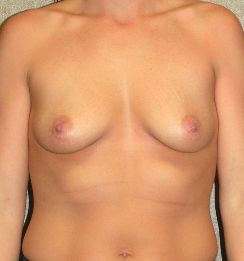 Mastopexy Augmentation Before & After Gallery - Patient 121378 - Image 1