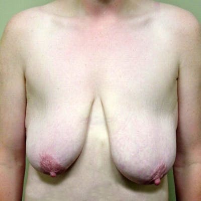 Breast Mastopexy Before & After Gallery - Patient 147053 - Image 1