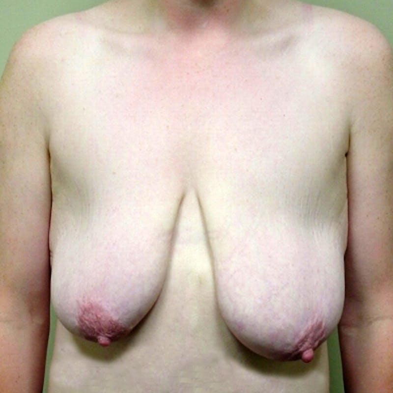 Breast Mastopexy Before & After Gallery - Patient 147053 - Image 1