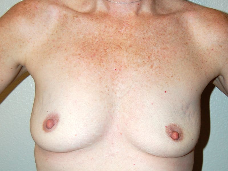 Mastopexy Augmentation Before & After Gallery - Patient 368204 - Image 1