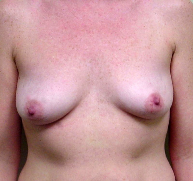 Mastopexy Augmentation Before & After Gallery - Patient 879108 - Image 1