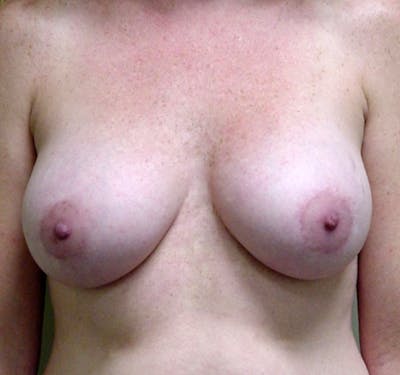 Mastopexy Augmentation Before & After Gallery - Patient 879108 - Image 2