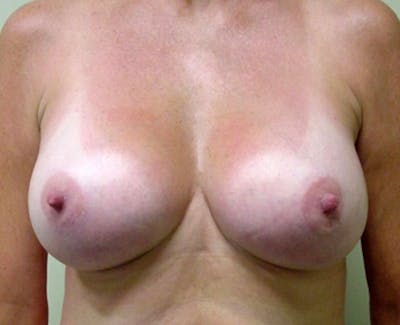 Mastopexy Augmentation Before & After Gallery - Patient 191785 - Image 2