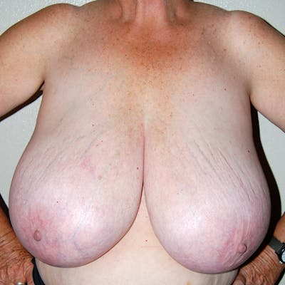 Breast Reduction Before & After Gallery - Patient 885418 - Image 1