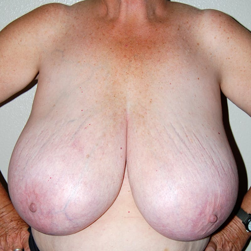 Breast Reduction Before & After Gallery - Patient 885418 - Image 1