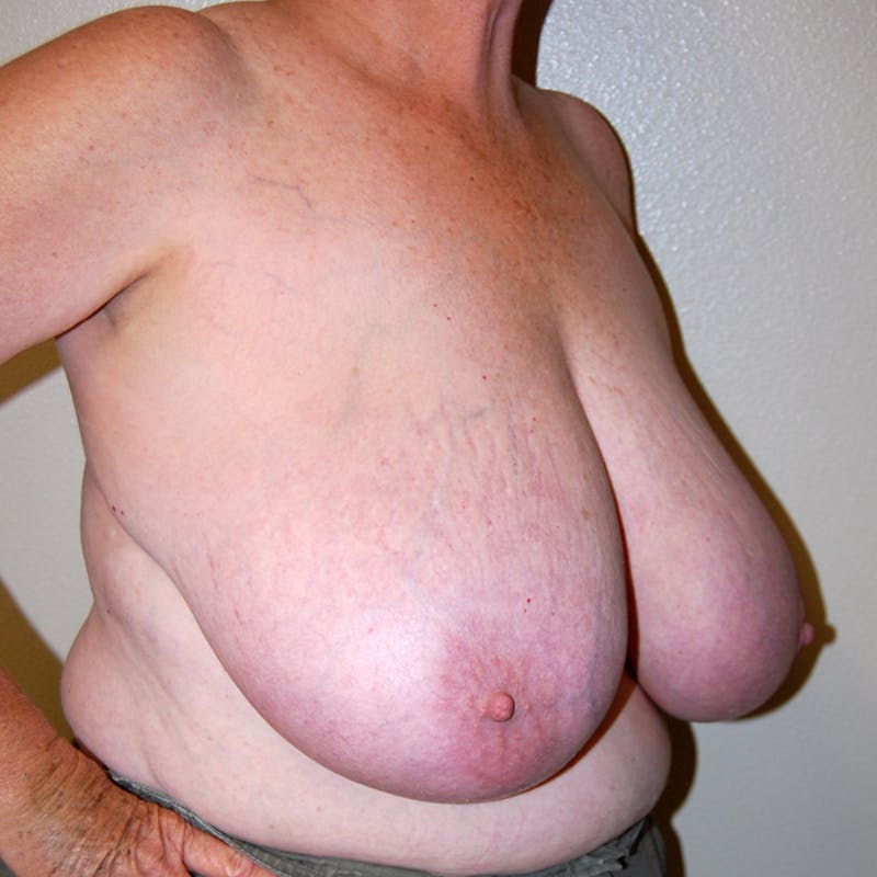 Breast Reduction Before & After Gallery - Patient 885418 - Image 3