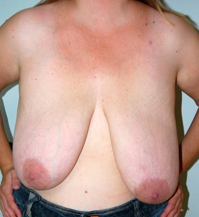 Breast Reduction Before & After Gallery - Patient 385960 - Image 1