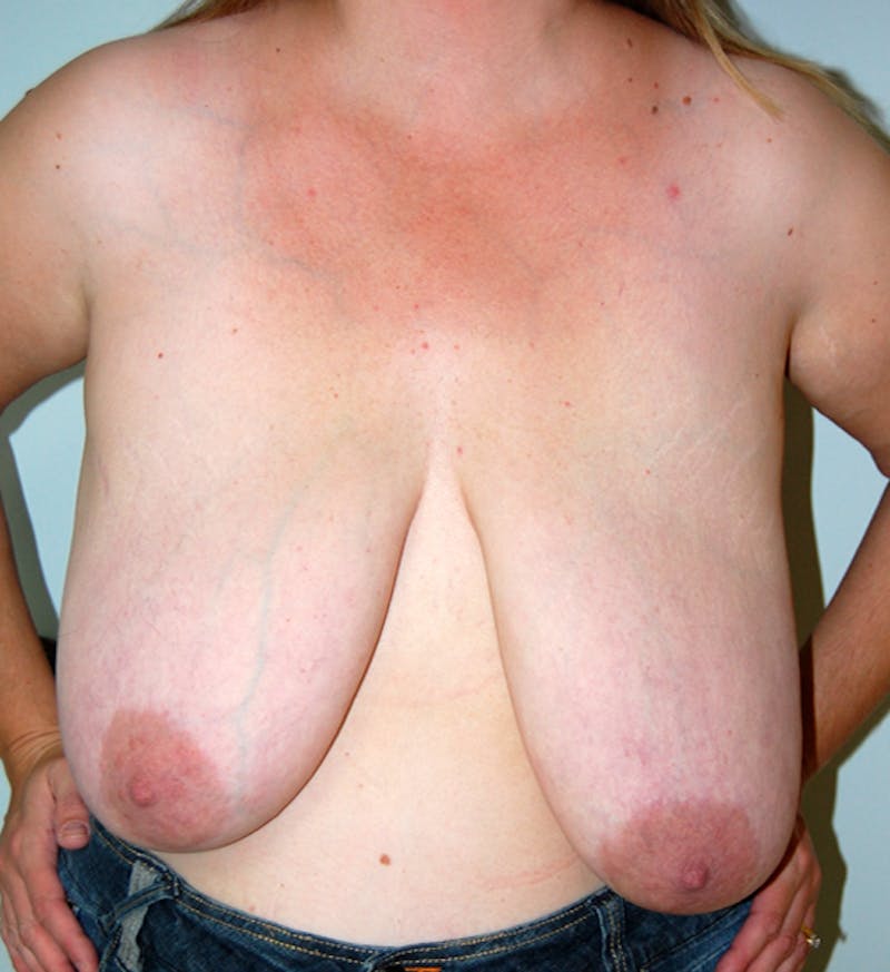 Breast Reduction Before & After Gallery - Patient 385960 - Image 1