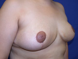 Breast Reduction Before & After Gallery - Patient 326857 - Image 4