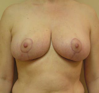 Breast Reduction Before & After Gallery - Patient 860452 - Image 2