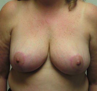 Breast Reduction Before & After Gallery - Patient 120226 - Image 2