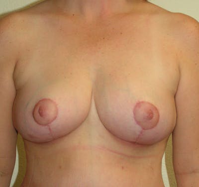 Breast Reduction Before & After Gallery - Patient 238148 - Image 2