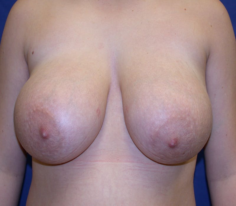 Breast Reduction Before & After Gallery - Patient 844153 - Image 1