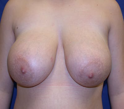 Breast Reduction Before & After Gallery - Patient 844153 - Image 1