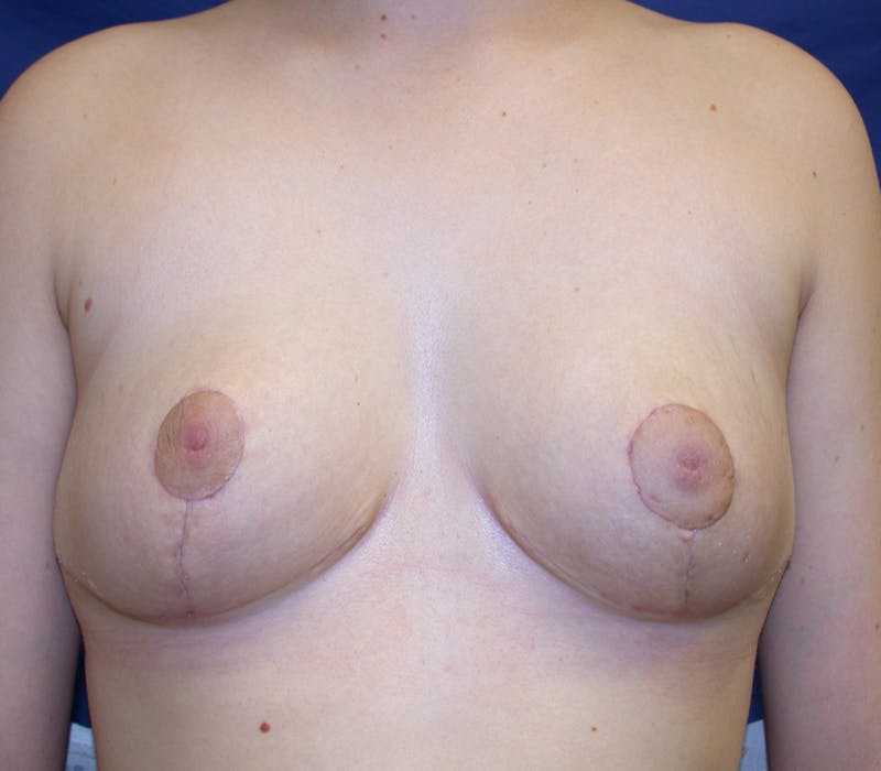 Breast Reduction Before & After Gallery - Patient 844153 - Image 2