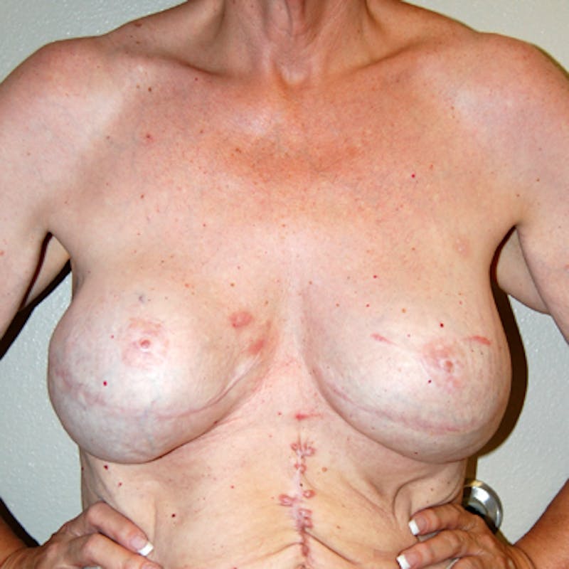 Breast Revision Before & After Gallery - Patient 120672 - Image 1