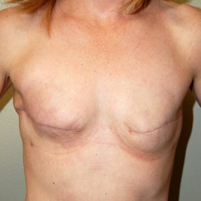 Breast Revision Before & After Gallery - Patient 226698 - Image 1