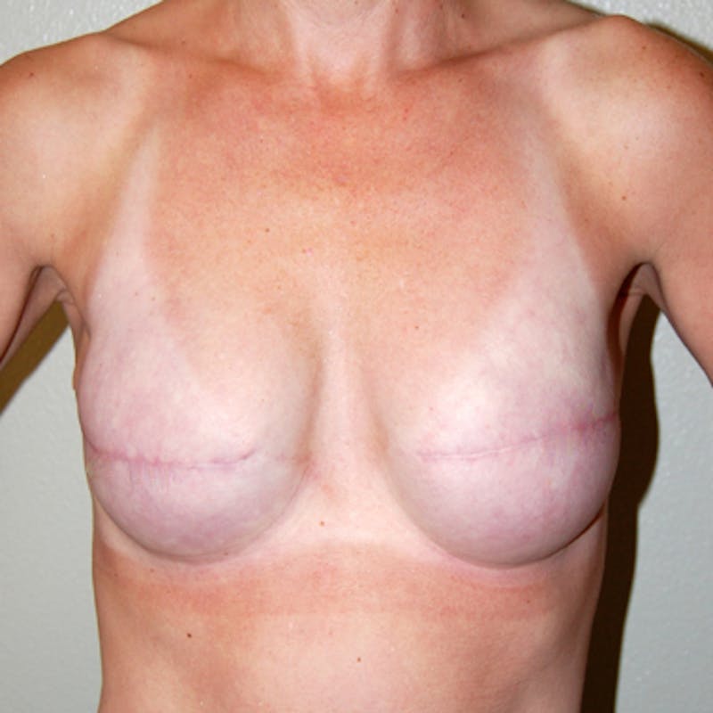 Breast Revision Before & After Gallery - Patient 226698 - Image 2