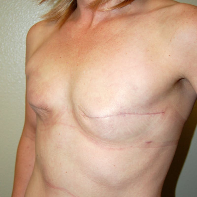 Breast Revision Before & After Gallery - Patient 226698 - Image 3