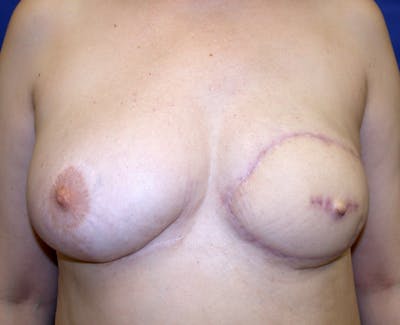 Breast Revision Before & After Gallery - Patient 456380 - Image 2