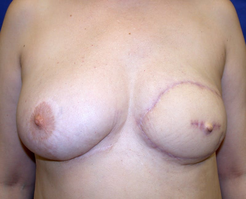 Breast Revision Before & After Gallery - Patient 456380 - Image 2