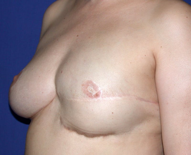 Breast Revision Before & After Gallery - Patient 456380 - Image 3