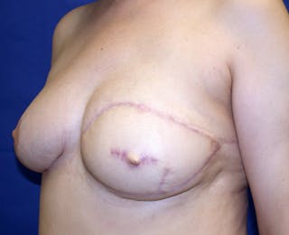 Breast Revision Before & After Gallery - Patient 456380 - Image 4