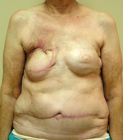 Breast Revision Before & After Gallery - Patient 149755 - Image 1