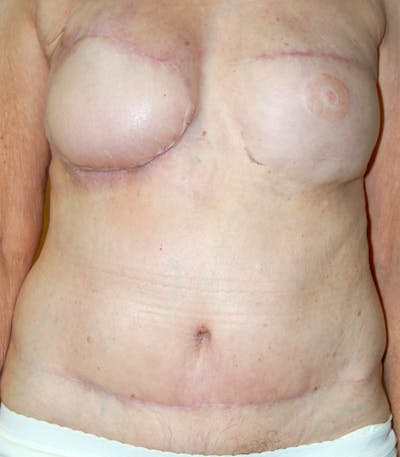 Breast Revision Before & After Gallery - Patient 149755 - Image 2
