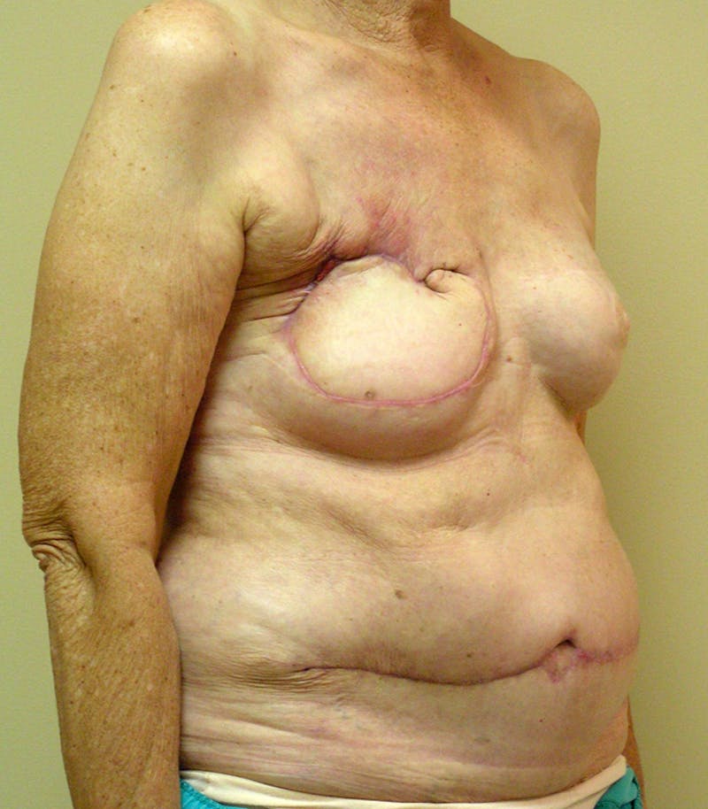 Breast Revision Before & After Gallery - Patient 149755 - Image 3