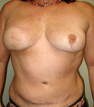 Breast Revision Before & After Gallery - Patient 264894 - Image 1