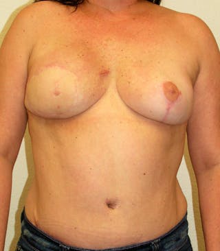 Breast Revision Before & After Gallery - Patient 264894 - Image 2