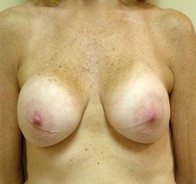 Breast Revision Before & After Gallery - Patient 338282 - Image 1