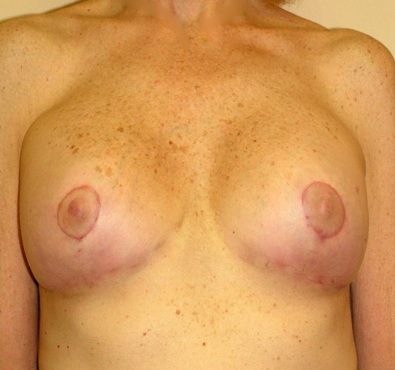 Breast Revision Before & After Gallery - Patient 338282 - Image 2