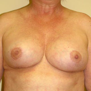 Breast Revision Before & After Gallery - Patient 415117 - Image 2