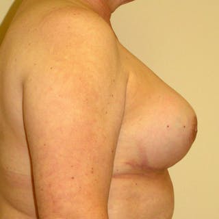 Breast Revision Before & After Gallery - Patient 415117 - Image 4