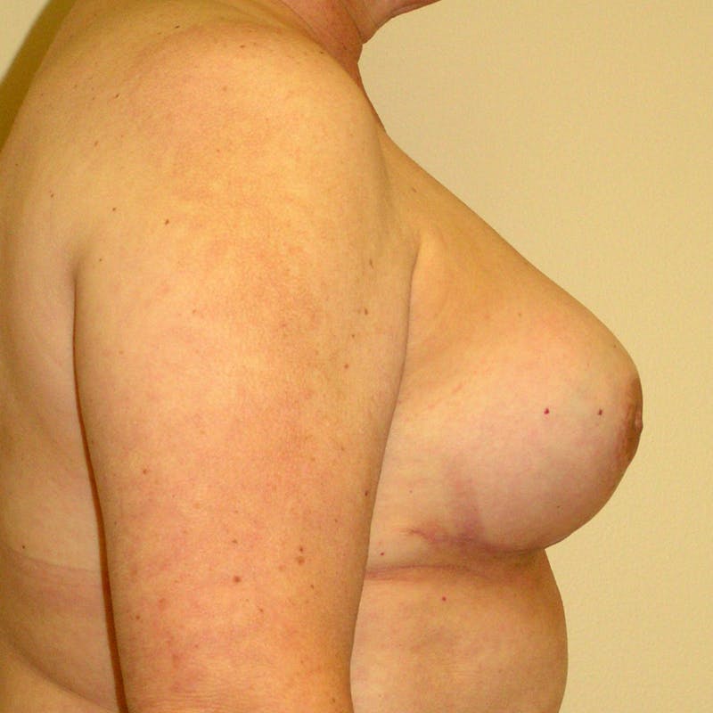 Breast Revision Before & After Gallery - Patient 415117 - Image 4
